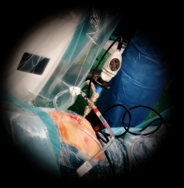 L'artroscopio consente di vedere su uno schermo le lesioni dell'anca e guida il chirurgo nella riparazione